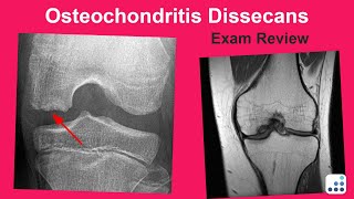 Osteochondritis Dissecans Exam Review  Mark Pagnano MD [upl. by Acinnor]