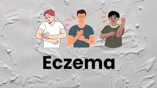 Eczema causes and treatment explained in Hindi [upl. by Cheyney]