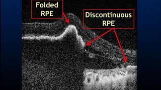 RPE Rip Noninvasive detection [upl. by Aleihs]