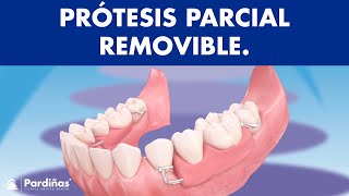 Prótesis parcial removible  ¿Cómo funcionan © [upl. by Husha]