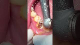 Tooth caries dentist dental viralvideo [upl. by Orenid688]