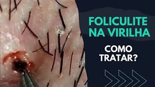 Foliculite na VIRILHA  COMO TRATAR  SAIBA [upl. by Salahcin]