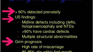 Trisomy 13 Patau syndrome sonographyultrasound findings [upl. by Daza324]