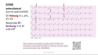 Herz 11 EKG 4  STEMI Perikarditis Extrasystole Kammerflimmern [upl. by Katrina]