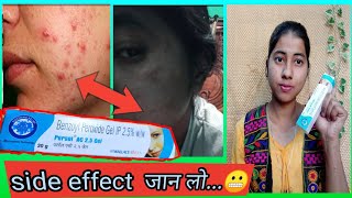 Benzoyl Peroxide Gel 25 Review In Hindi  Uses And Side Effect  miss glossy girl [upl. by Swerdna]