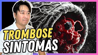 SINTOMAS DA TROMBOSE [upl. by Eloisa]