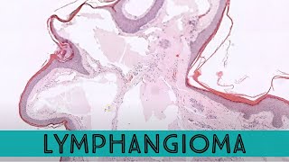 Lymphangioma Lymphatic Malformation under the microscope pathology dermpath dermatology [upl. by Yelahc432]