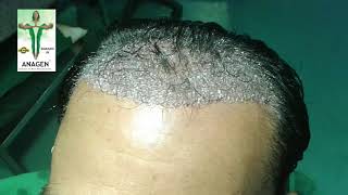 Hair Transplant in BhopalRs15hairgraft Call or WhatsApp 9222222409 [upl. by Goddart]