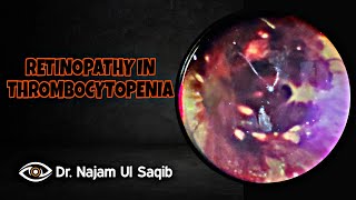 Retinopathy In Thrombocytopenia Indirect Ophthalmoscopy [upl. by Sarid]