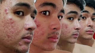 100 DAYS OF ISOTRETINOIN TIMELAPSE  Accutane Acnetrex Progress Video  KevInSeries [upl. by Retswerb]