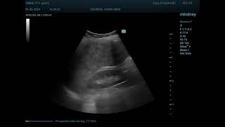 Primary biliary cirrhosis [upl. by Essy]