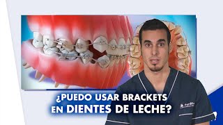 Solo tengo UN DIENTE TORCIDO ¿necesito usar BRACKETS ¿Y si es diente de leche  Shorts [upl. by Lovmilla]