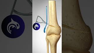 Distal Femoral Osteotomy of the Knee  3D animation knee kneepain orthopedics [upl. by Riorsson748]