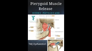 Pterygoid Muscle Release For Temporomandibular Joint Dysfunction TMJ Dysfunction [upl. by Kiker]