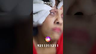 Milia Removal Treatment  Dr Rohit Goel [upl. by Alamak897]