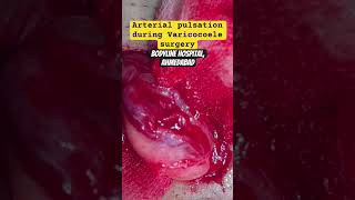 Testicular Artery pulsation during Varicocoele surgery varicoceletreatment andrologist urologist [upl. by Gunter]