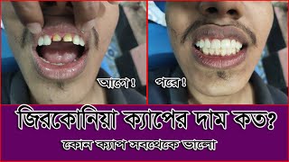 Zirconia Crown Price in Bangladesh  জিরকোনিয়া ক্যাপের দাম  কোন ক্যাপ ভালো ।। স্বাস্থ্য সেবা [upl. by Rora]