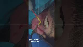 Mucocele removal youtube dentistnearby shortvideos dentalclinic dentist trending viral [upl. by Targett]