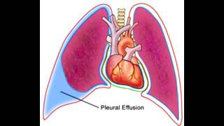 Pleural Effusions  Transudate Exudate amp Lymphatic [upl. by Baylor]