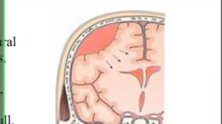 Brain Hematomas  EMS Head Injury Patients [upl. by Eicyak871]