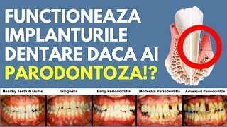 Sunt indicate implanturile dentare la pacientii cu parodontoza  Dr Andrei Stan [upl. by Robinetta]