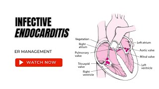 Infective Endocarditis [upl. by Ahsakat]