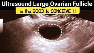 what is Large Ovarian Follicle  is it GOOD to CONCEIVE  TVS Ultrasound [upl. by Gardell752]