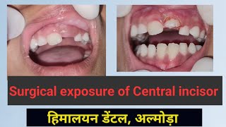 Surgical Tooth Exposure by RF Cautery [upl. by Irod441]