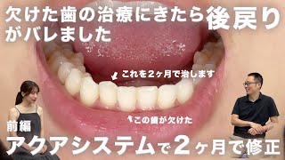 【後戻り２ヶ月治療】歯が欠けたので治療に来たら後戻りがバレました【前編】 [upl. by Gemoets]