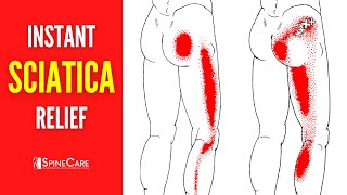 How to Instantly Fix Sciatica Pain [upl. by Aldin857]