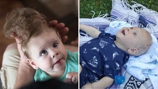 Baby Born with Brain Outside of Skull Gets LifeChanging Surgery [upl. by Wilek251]