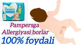 Pampersda bolaga allergiya bersa foydali 100 effekt beradi onalar uchun layfxak tavsiya qilaman [upl. by Cal318]