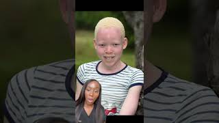 Albinism Understanding the Genetic Condition and Its Impact [upl. by Tihor]