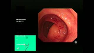 Colonic Angiodysplasia and APC treatment [upl. by Creamer25]