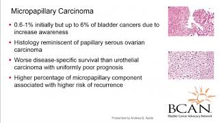 Bladder Cancer Urothelial Carcinoma [upl. by Ellertal]