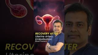 Recovery after Uterine Artery Embolisation  Recovery Time after Uterine Fibroid Embolization UFE [upl. by Aivart]