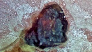 Huge Scab Picked Off Under Microscope [upl. by Eneleahcim]