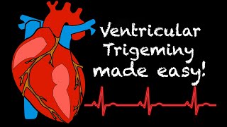 EMS Cardiology  Tachy Tuesday Ventricular Trigeminy [upl. by Aivirt]