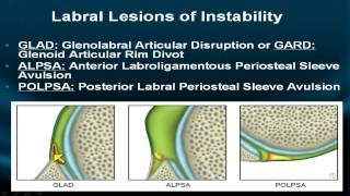 Shoulder MRI Instability Part IV [upl. by Darreg]