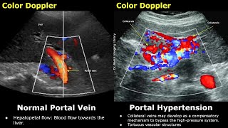 Portal Vein Color amp Spectral Doppler Ultrasound Normal Vs Abnormal Images  Liver Vascular USG Scan [upl. by Yreva]