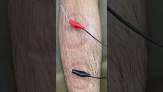 L4 L5 nerve compression acupuncture treatment [upl. by Eelac]