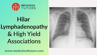 CXRs Hilar Lymphadenopathy and High Yield Associations for the USMLE [upl. by Jaclin105]