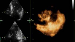 3D MITRAL REGURGITATION PROLAPSE P2 AND P3 [upl. by Rexer213]