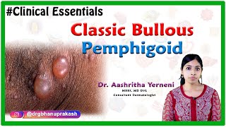 Classic bullous pemphigoid Clinical essentials Dr Aashritha yerneni [upl. by Nimsay]