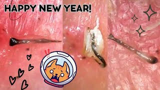 Hair Follicle Plucks Under the Microscope Super Satisfying Ingrown Hair Removal  BIG Hair Roots [upl. by Siuqaj619]