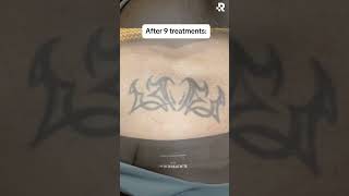 Before amp After Tattoo Removal at Removery🤩 [upl. by Okomot]