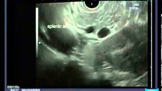 Radial Endoscopic Ultrasound  Anatomical Guiding Structures in the Upper Abdomen [upl. by Lramaj]