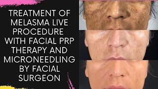 Treatment of Melasma Live Procedure with Facial PRP Therapy and Microneedling by Facial Surgeon1 [upl. by Ardyce]