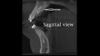 Surgical Removal of an Impacted Supernumerary Toothقلع جراحي لسن زائد منطمر حنكيا [upl. by Ynnal]