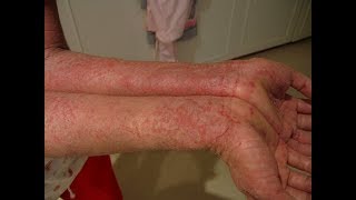 Treatment of eczema and other skin diseases [upl. by Acirem]